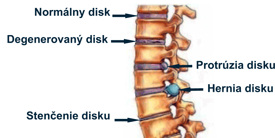 Protruzia disku a hernia disku