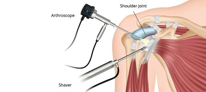 Artroskopia ramena