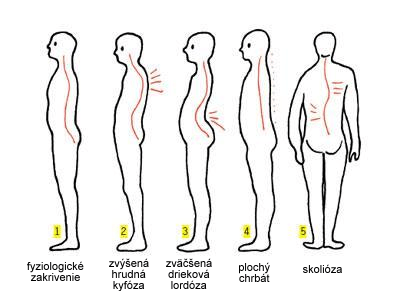 Správne držanie tela proti bolesti chrbta